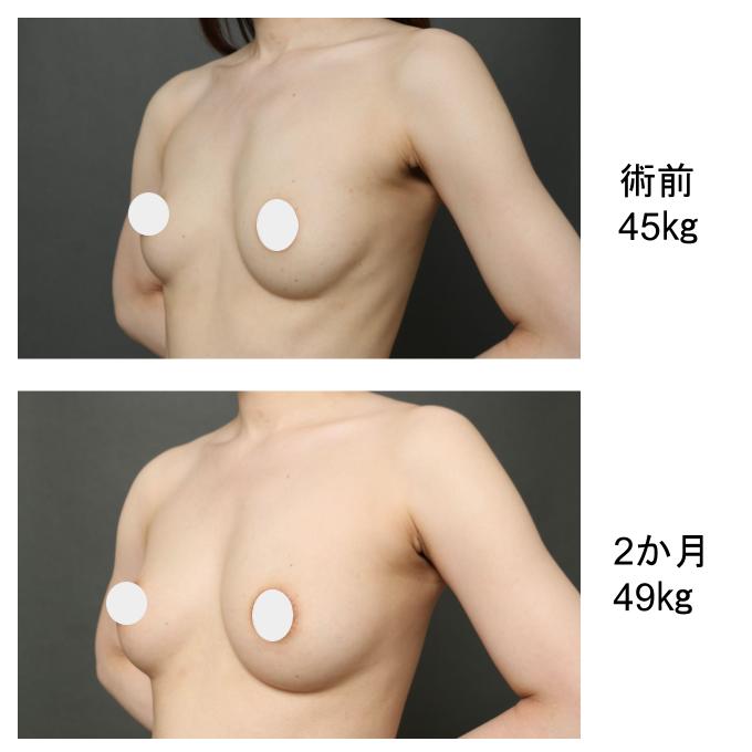 エクソソーム豊胸で胸を大きく、太ももを細く!