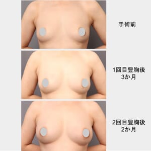 2回のエクソソーム豊胸の経過　164cm　61kg　36歳