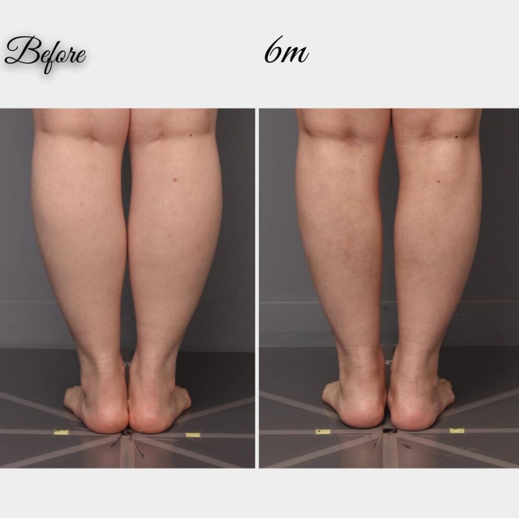 下腿（ふくらはぎ）の脂肪吸引　術後６か月　156㎝　64㎏　44歳