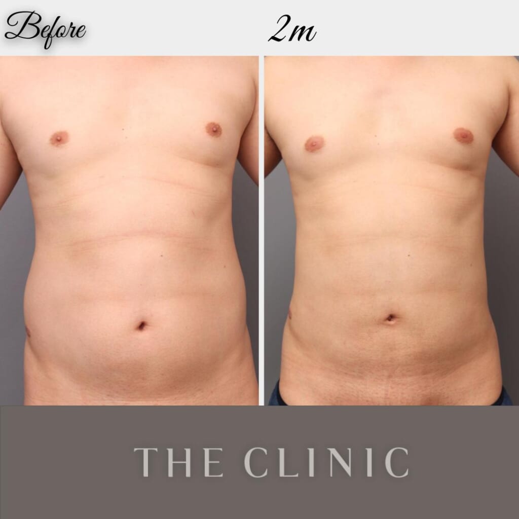 男性の上下側腹部、腰の脂肪吸引　術後2ヵ月　173㎝　77㎏　35歳