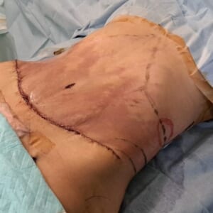 閲覧注意！　タミータック（腹部のたるみ切除）の手術中写真　162㎝　49㎏　34歳