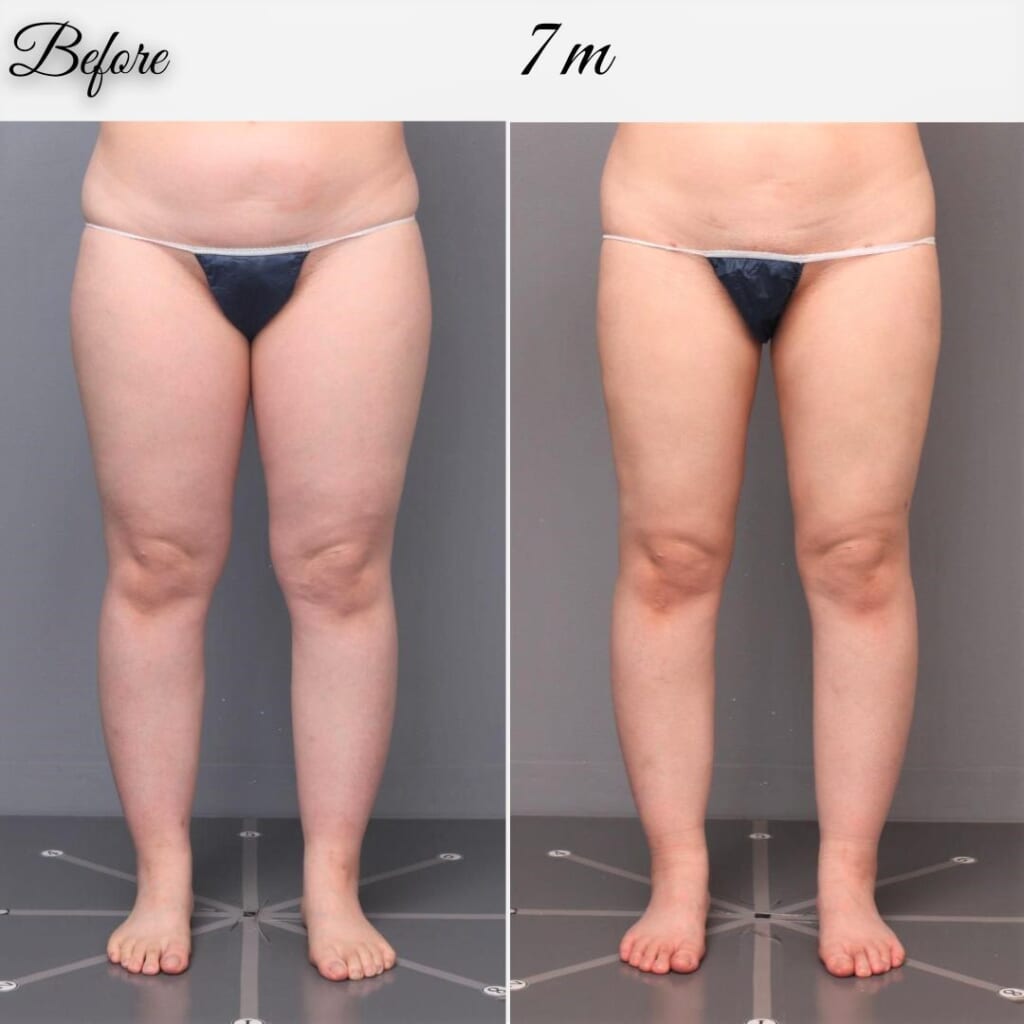 太ももの脂肪吸引（大腿全周+膝）　術後7か月　156㎝　73㎏　33歳