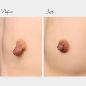 乳頭縮小+エクソソーム豊胸で授乳前のお胸へ！　158㎝　46㎏　36歳