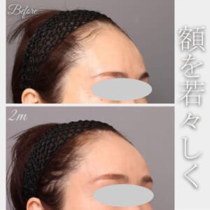 額、こめかみの脂肪注入　術後2か月　52歳