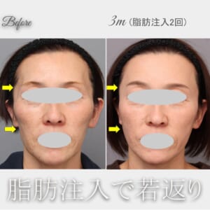 脂肪注入による若返り！　術後3か月（2回目の脂肪注入後）　47歳