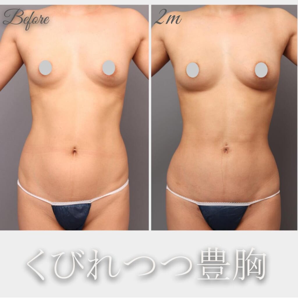 メリハリボディへ! 腹+腰の吸引→脂肪豊胸 術後2か月 155㎝ 49㎏ 37歳