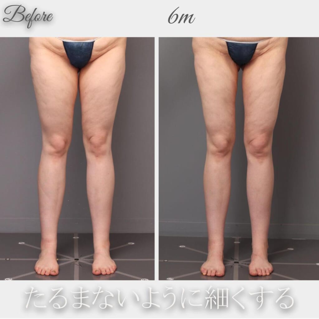 たるまないように吸引する! 太ももの脂肪吸引(大腿前、内) 術後6か月 177㎝ 70㎏ 29歳