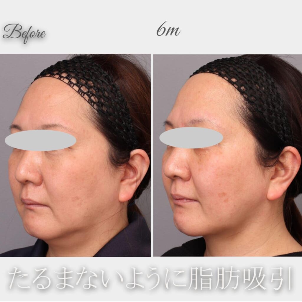 脂肪吸引でお顔のもたつきを解消! 頬、顎の脂肪吸引 術後6か月 165㎝ 79㎏ 49歳