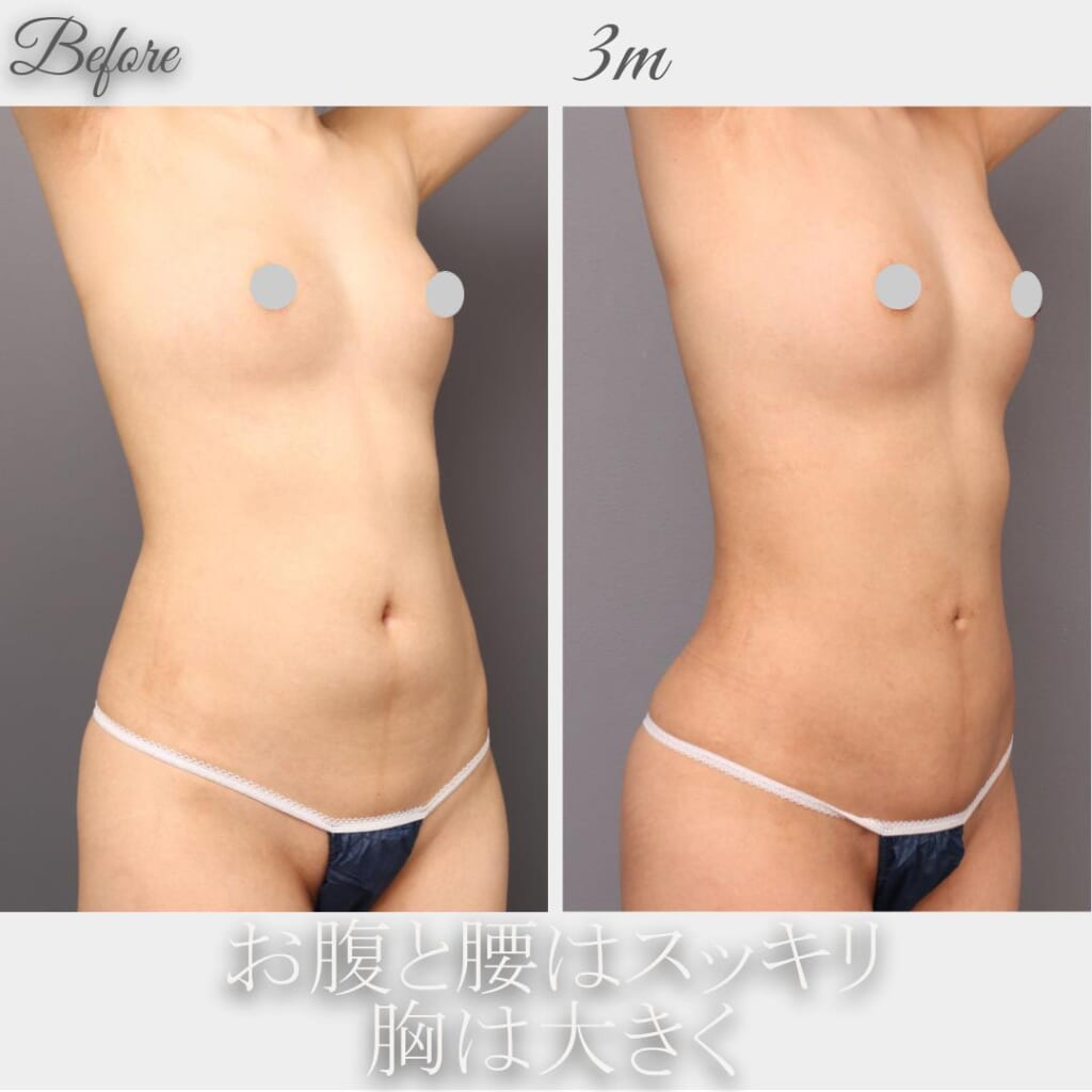 腹部+腰の吸引→脂肪豊胸　術後3か月　156㎝　45㎏　33歳