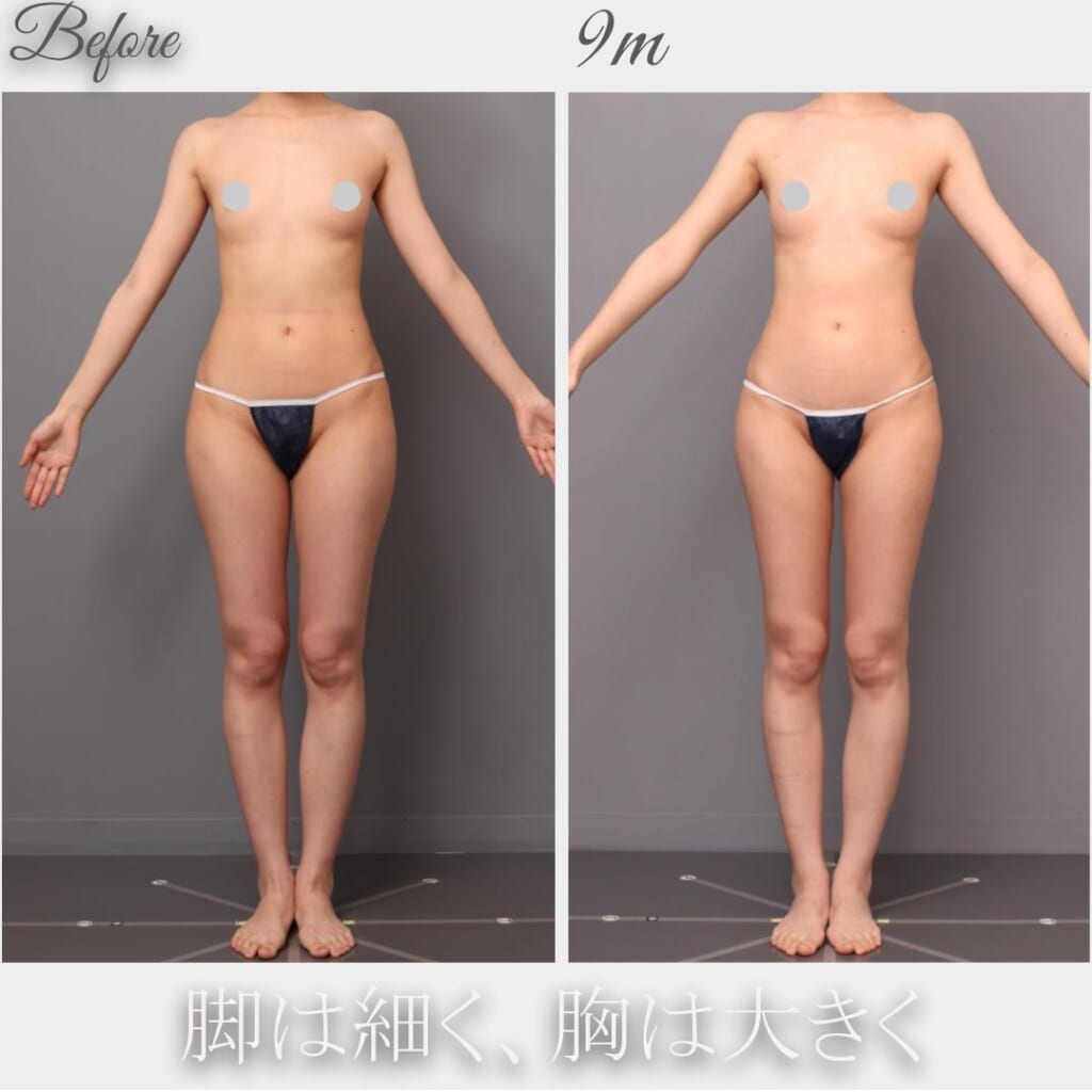 太もも内外側の吸引→脂肪豊胸　術後9か月　165㎝　48㎏　24歳