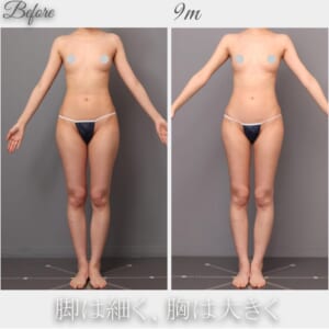 太もも内外側の吸引→脂肪豊胸　術後9か月　165㎝　48㎏　24歳