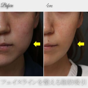 頬の脂肪吸引　術後4か月　163㎝　51㎏　29歳