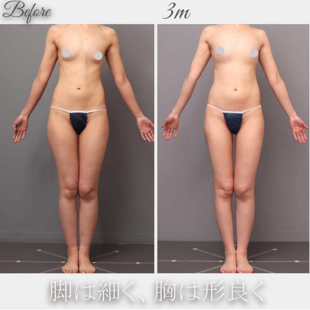 太もも内外側の吸引→脂肪豊胸　術後3か月　166㎝　52㎏　27歳
