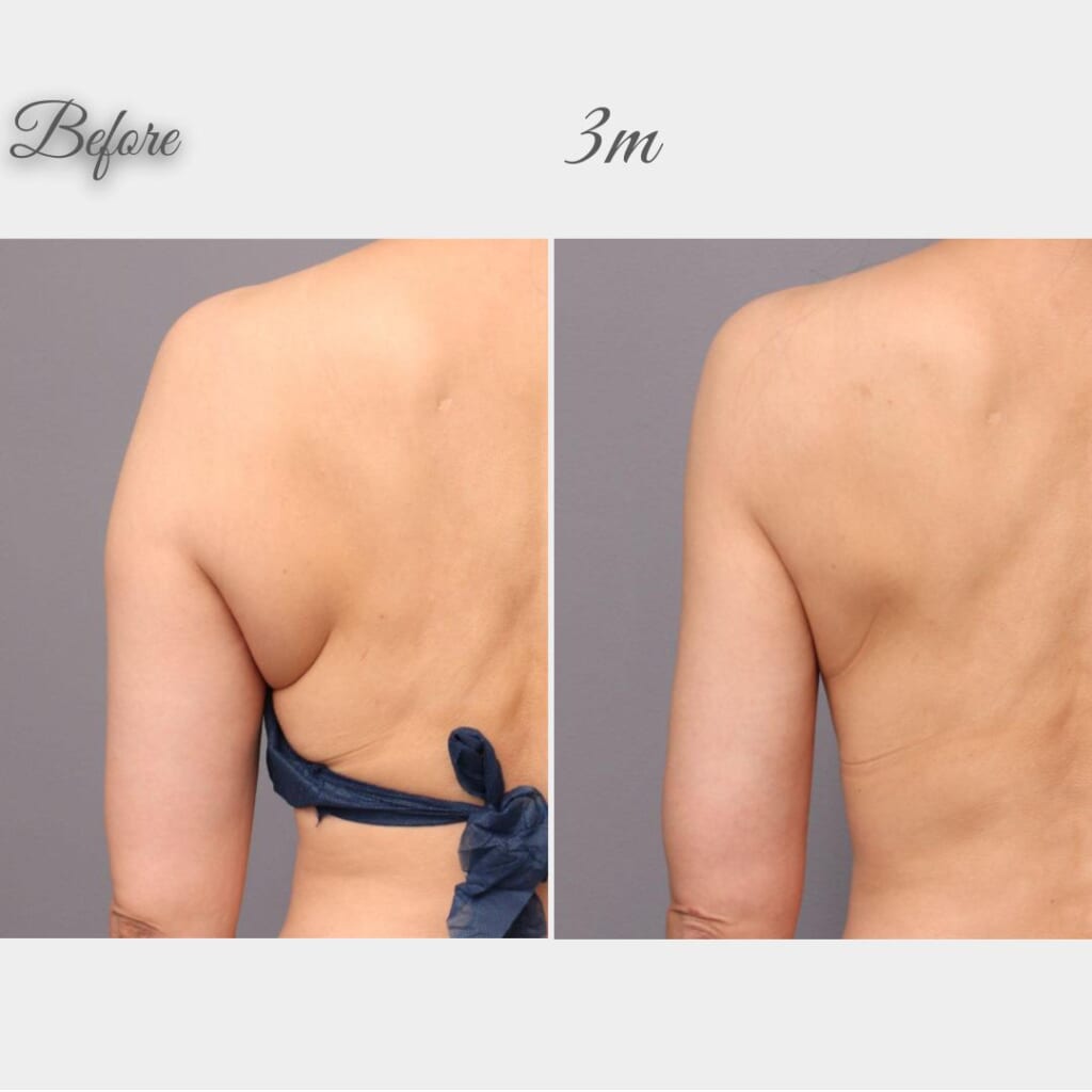 脇肉、二の腕、肩の脂肪吸引　術後3か月　162㎝　57㎏　51歳