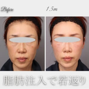 全顔脂肪注入　術後1.5か月　53歳