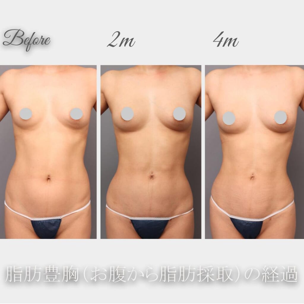 腹+腰の吸引→脂肪豊胸　術後4か月までの経時的変化　155㎝　49㎏　37歳