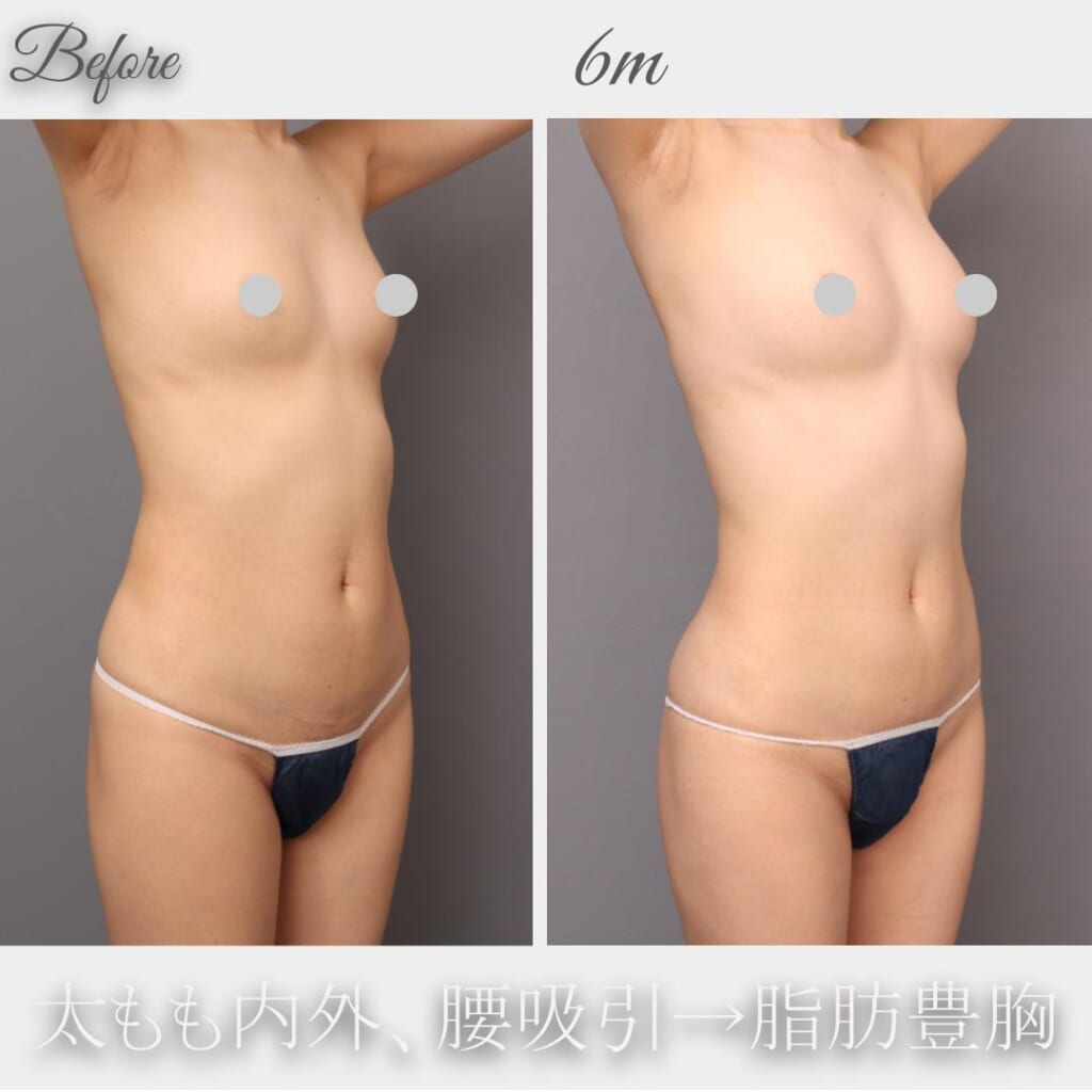 腰、太もも内外の吸引→脂肪豊胸　術後6か月　162㎝　50㎏　29歳