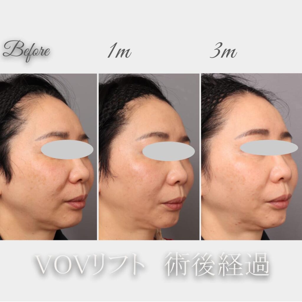VOVリフト 3か月間の術後経過 49歳