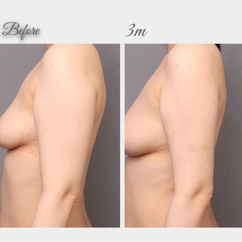 二の腕、肩の脂肪吸引　術後3か月　164㎝　60㎏　39歳