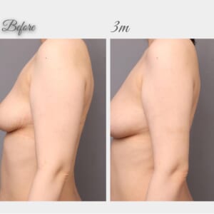 二の腕、肩の脂肪吸引　術後3か月　164㎝　60㎏　39歳