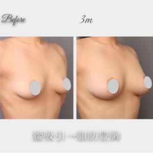 腰の吸引→脂肪豊胸　術後3か月　157㎝　51㎏　27歳