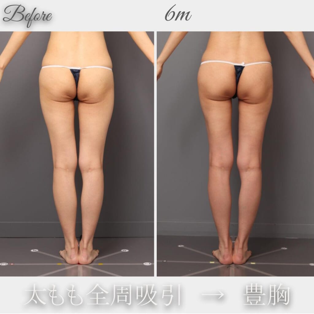 太もも全周の吸引→脂肪豊胸 術後6か月 165㎝ 46㎏ 42歳