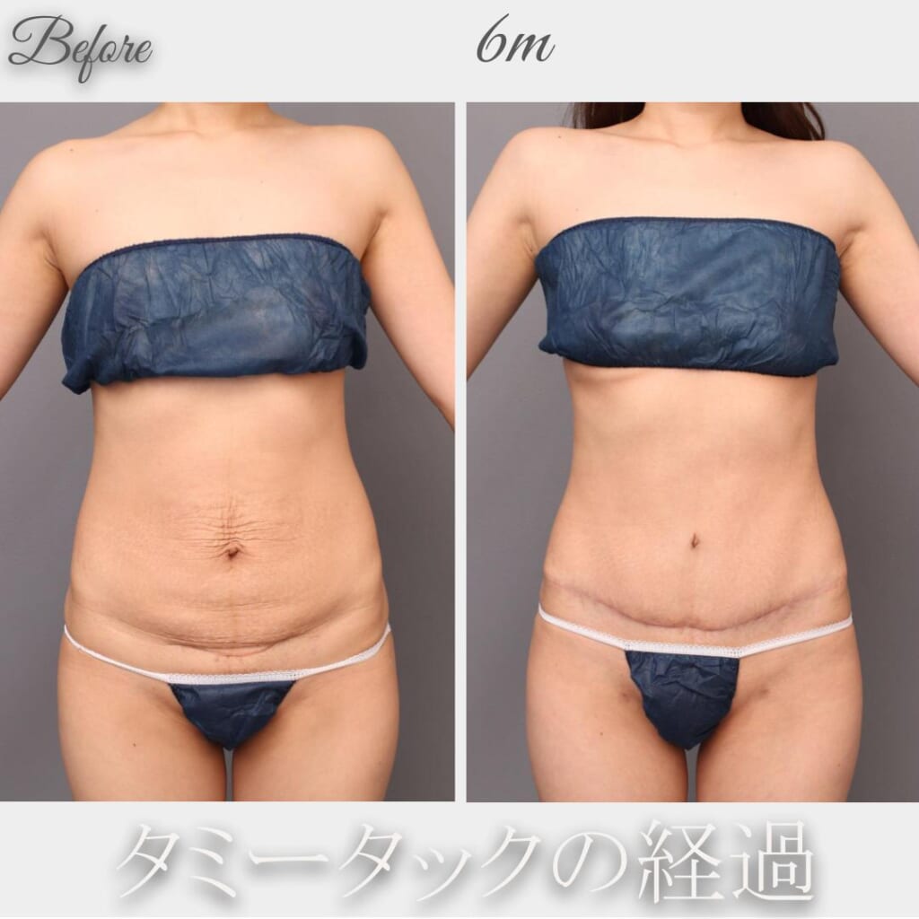 タミータックの術後経過 手術後6か月まで 162㎝ 49㎏ 34歳