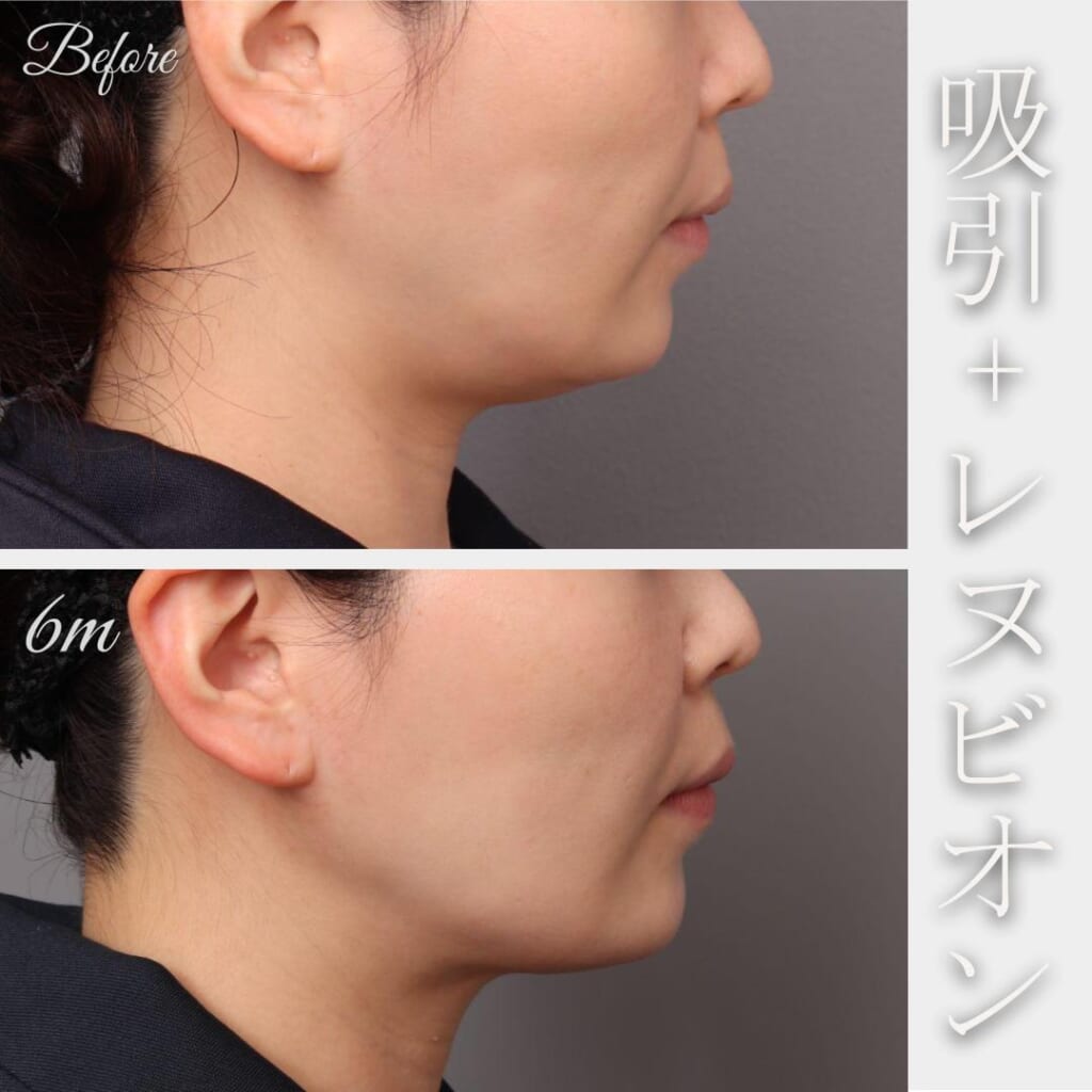 顎下の脂肪吸引+レヌビオン 術後6か月 155㎝ 50㎏ 39歳