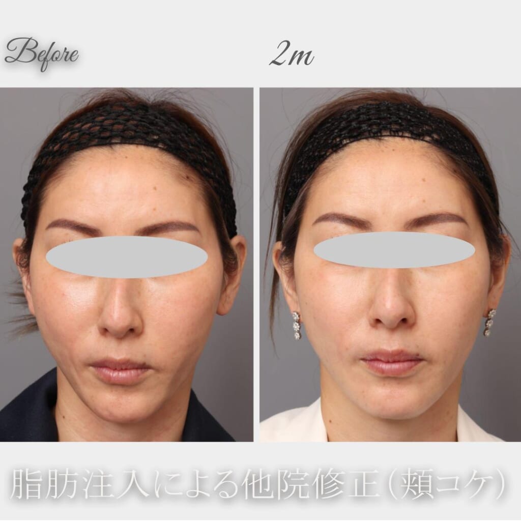 他院脂肪吸引後の頬コケに対する脂肪注入 44歳