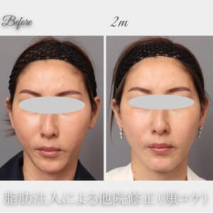 他院脂肪吸引後の頬コケに対する脂肪注入　44歳